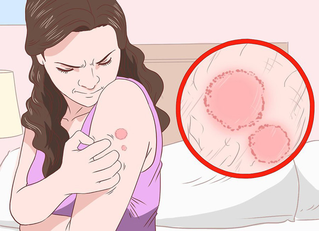 درمان عفونت قارچ پوستی